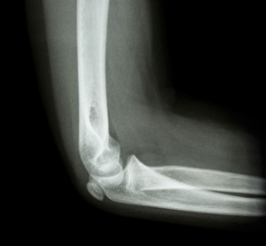 arm-bone