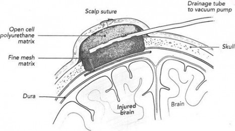 tbi-va
