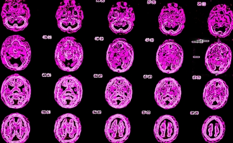 http://www.dreamstime.com/stock-images-pet-ct-brain-nuclear-medicine-very-specific-exam-radiopharmaceutical-must-be-injected-right-time-short-time-image40709134