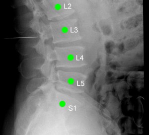 LevelCheck software clearly labels each vertebra in this X-ray image taken just before a patient's spinal surgery. Note the pin to the left of L3. L and S stand for the lumbar and sacral regions of the spine, respectively. (Photo courtesy of Johns Hopkins Medicine.)