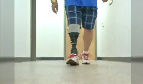 Triton foot-ankle prosthetic is demonstrated by Philip Nielsen. (Image from Fox 40 News report)